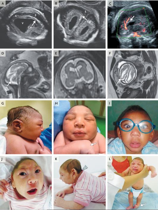 Congenital Zika Virus Syndrome