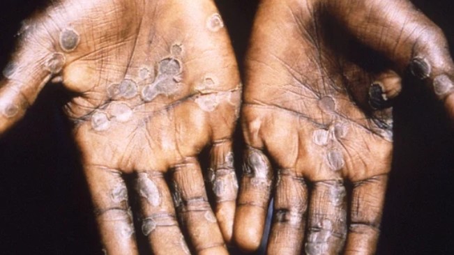 Monkeypox Representative imag